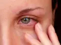 Swędzą Cię oczy? Alergia na płyn do soczewek co robić?