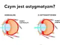 Astygmatyzm: okulary czy soczewki? Porównaj i wybierz mądrze!