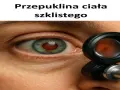Badanie oka, widoczne odklejenie ciałka szklistego.
