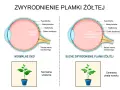 Porównanie zdrowego oka z plamką żółtą i oka z jej zwyrodnieniem. Obrazek pokazuje, jak plamka żółta wpływa na widzenie.