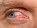 Silne zaczerwienienie oka, widoczne naczynka, sugerujące ból oka przy poruszaniu gałką.