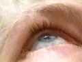 Zbliżenie na oko, widoczne rzęsy i brwi. Może to być związane z zespołem Hornera, który wpływa na wygląd oka.