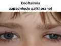 Widoczne zapadnięte oczodoły, objaw enoftalmii.