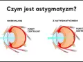 Astygmatyzm: Skąd się bierze? Geny, urazy, choroby wszystko o nim