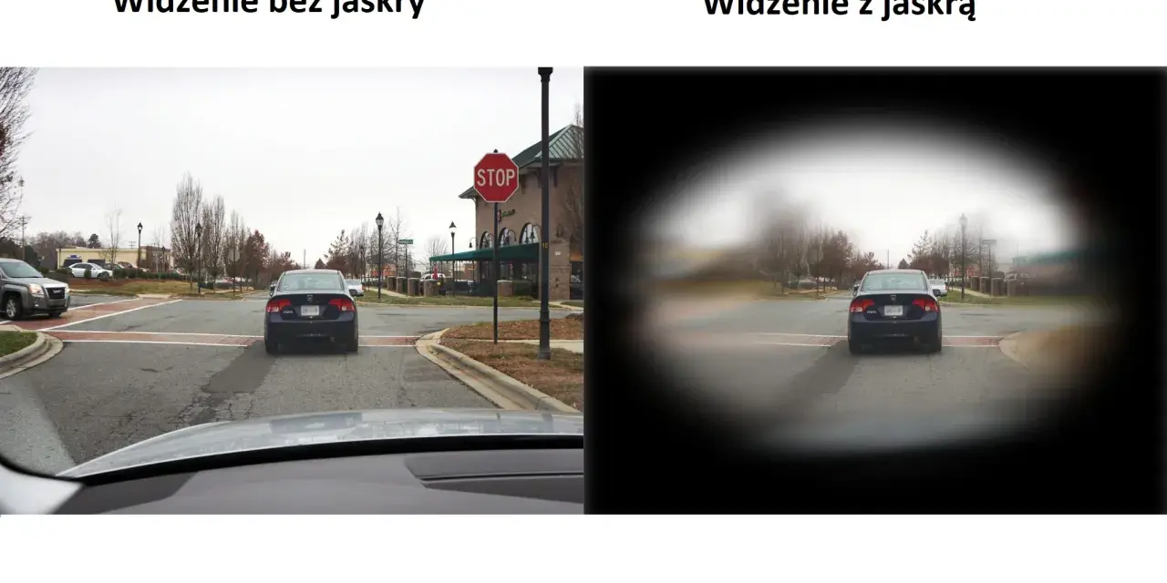 Porównanie widzenia: po lewej normalne, po prawej z jaskrą, gdzie centralne pole widzenia jest zamazane.