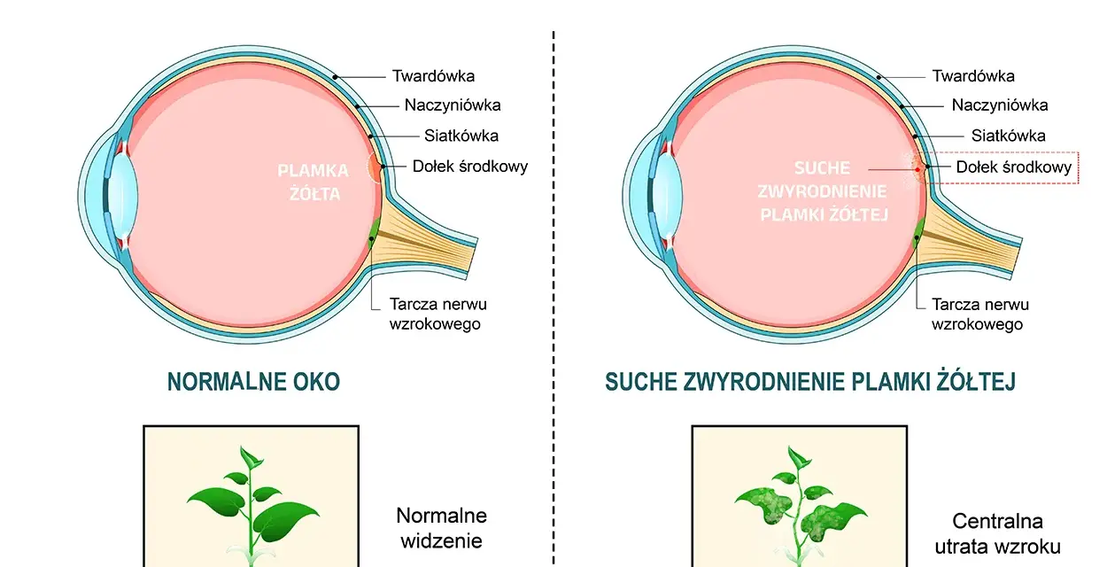 Porównanie zdrowego oka z plamką żółtą i oka z jej zwyrodnieniem. Obrazek pokazuje, jak plamka żółta wpływa na widzenie.