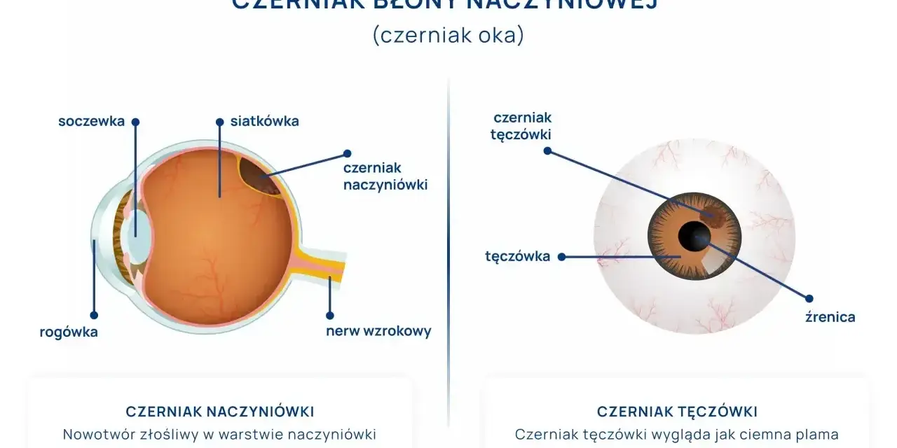 Schemat oka z zaznaczonym czerniakiem naczyniówki i czerniakiem tęczówki. Czerniak oka to poważna choroba.