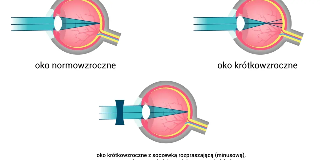 Oko normowzroczne, krótkowzroczne i krótkowzroczne z soczewką korygującą. Światło skupia się na siatkówce, a spojówka jest zdrowa.