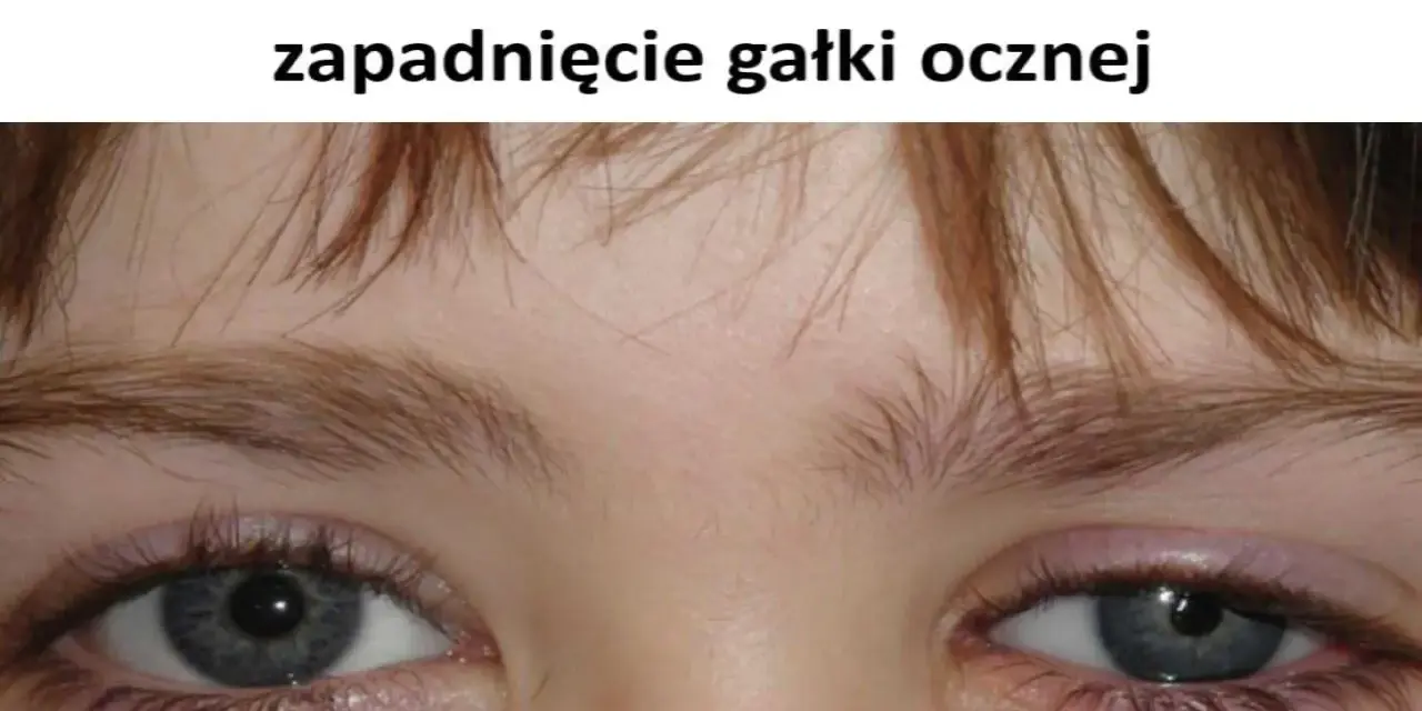 Widoczne zapadnięte oczodoły, objaw enoftalmii.