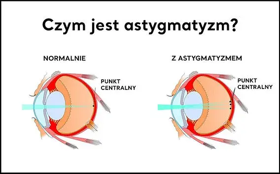 Astygmatyzm: Skąd się bierze? Geny, urazy, choroby wszystko o nim