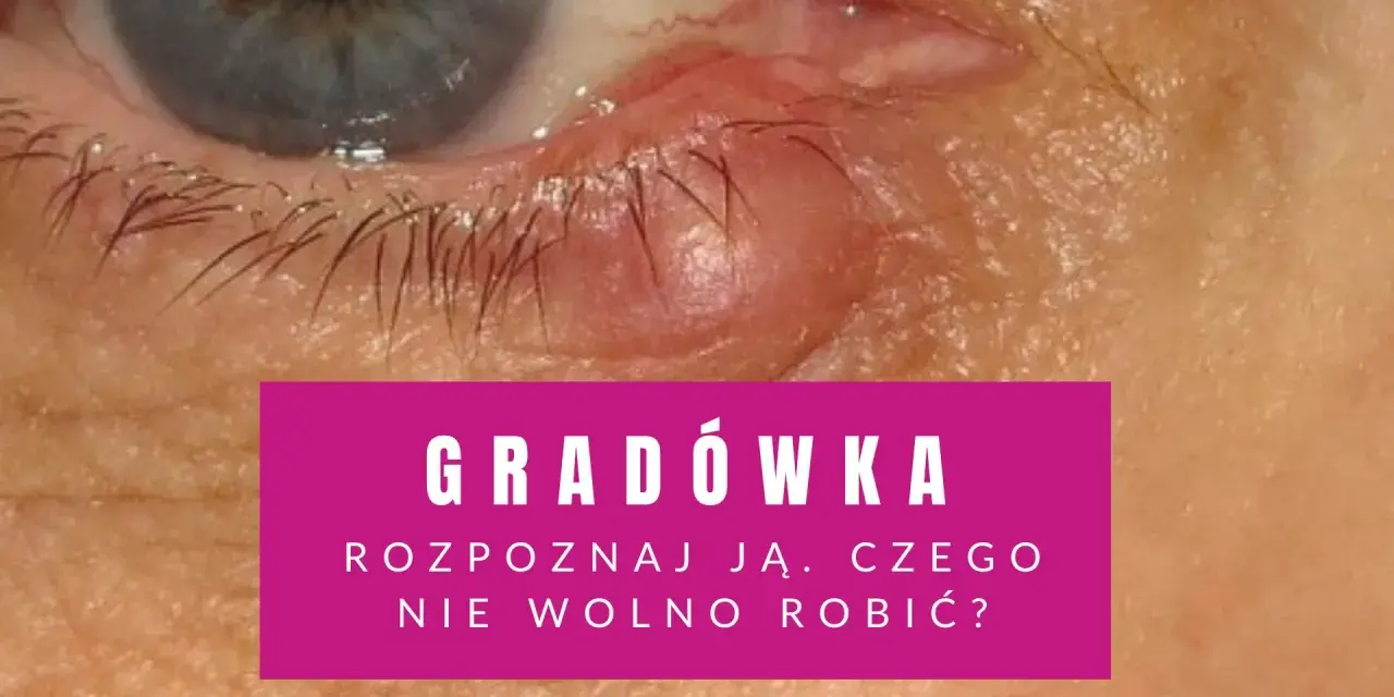 Widoczna gradówka wewnątrz powieki, czerwona i opuchnięta. Tekst informuje o rozpoznawaniu i postępowaniu.