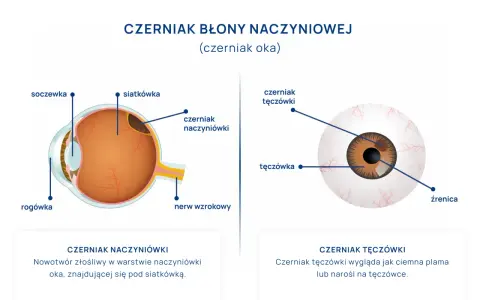 Schemat oka z zaznaczonym czerniakiem błony naczyniowej. Pokazuje czerniaka naczyniówki pod siatkówką i czerniaka tęczówki.