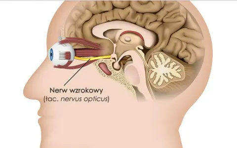 Przekrój głowy z okiem i nerwem wzrokowym. Czy zapalenie nerwu wzrokowego zawsze oznacza SM? Niekoniecznie, ale warto zbadać przyczynę.