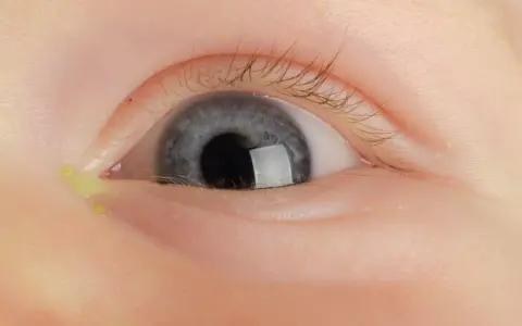 Niemowlęce, szare oko z widocznym ropiejącym kącikiem. Żółta wydzielina gromadzi się przy rzęsach.