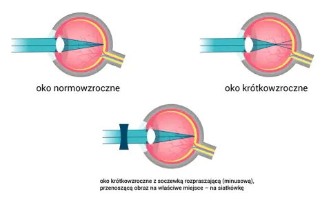 Oko normowzroczne, krótkowzroczne i krótkowzroczne z soczewką korygującą. Światło skupia się na siatkówce, a spojówka jest zdrowa.