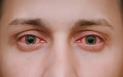 Silne zapalenie oka, widoczne zaczerwienienie spojówek i obrzęk powiek.