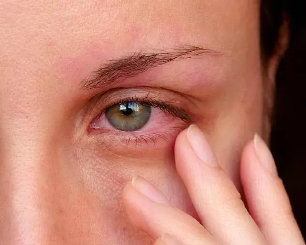 Swędzą Cię oczy? Alergia na płyn do soczewek co robić?