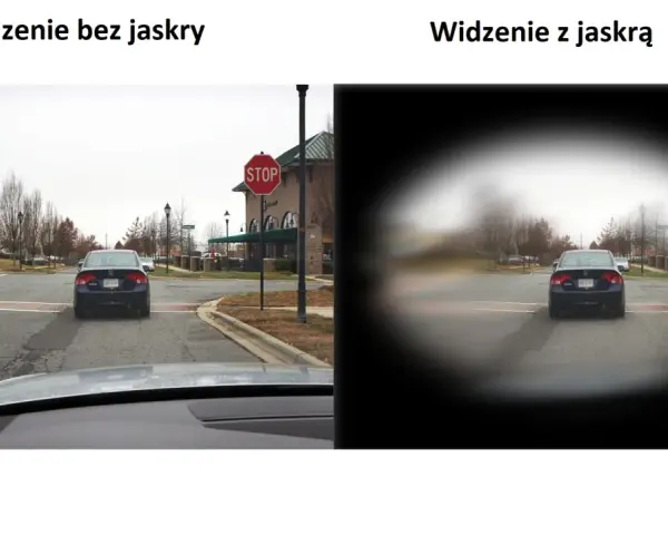 Porównanie widzenia: po lewej normalne, po prawej z jaskrą, gdzie centralne pole widzenia jest zamazane.