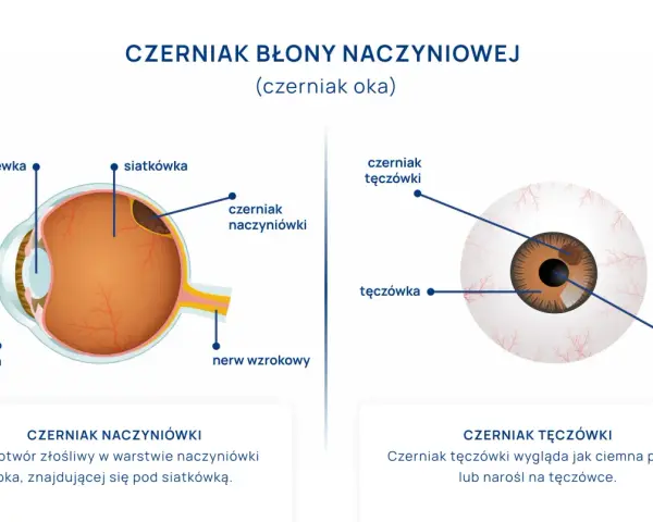Schemat oka z zaznaczonym czerniakiem błony naczyniowej. Pokazuje czerniaka naczyniówki pod siatkówką i czerniaka tęczówki.
