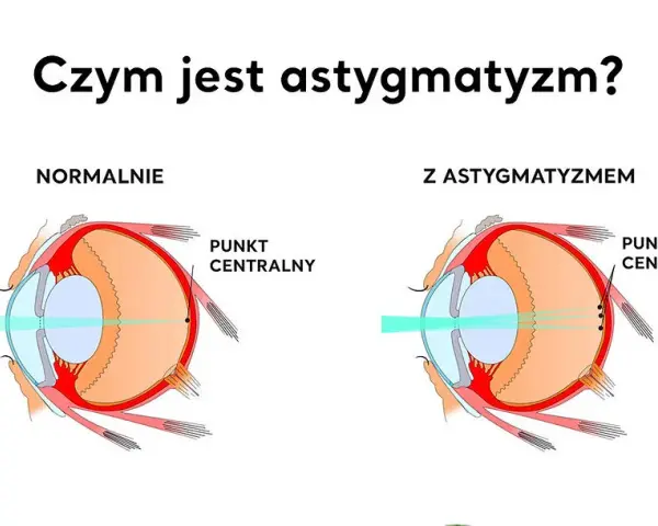 Astygmatyzm: okulary czy soczewki? Porównaj i wybierz mądrze!
