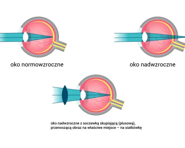 Ilustracja porównuje funkcje oka: normowzrocznego, nadwzrocznego i nadwzrocznego z soczewką korygującą, pokazując skupianie światła na siatkówce.