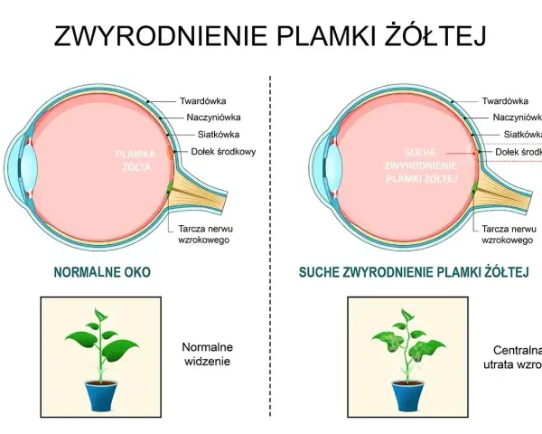 Porównanie normalnego oka z suchym zwyrodnieniem plamki żółtej. Obrazek pokazuje, jak obrzęk plamki żółtej wpływa na widzenie.