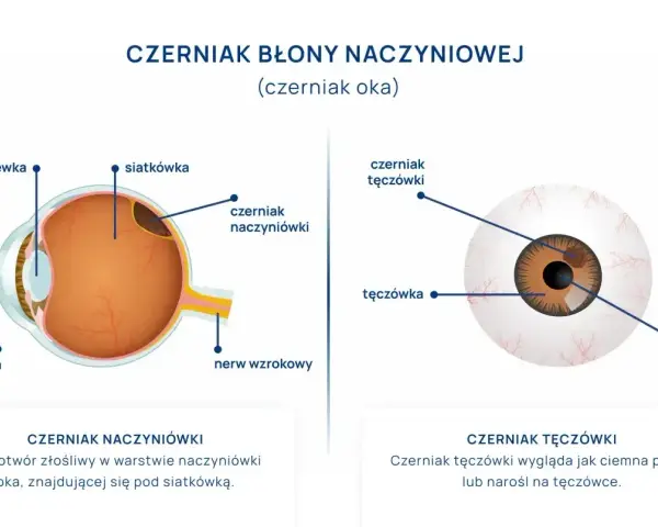 Schemat oka z zaznaczonym czerniakiem naczyniówki i czerniakiem tęczówki. Czerniak oka to poważna choroba.