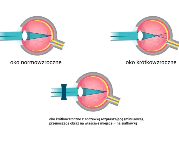 Oko normowzroczne, krótkowzroczne i krótkowzroczne z soczewką korygującą. Światło skupia się na siatkówce, a spojówka jest zdrowa.