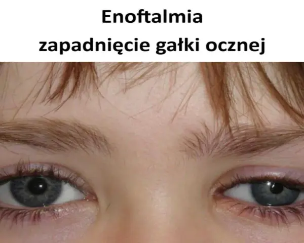 Widoczne zapadnięte oczodoły, objaw enoftalmii.