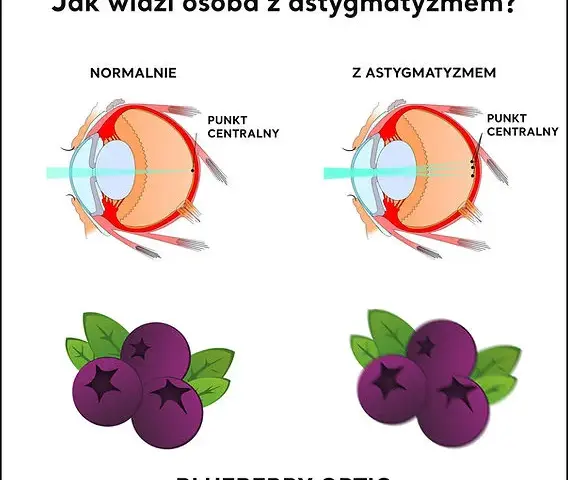 Astygmatyzm: Plusy, minusy i cylinder? Zrozum swoją wadę!