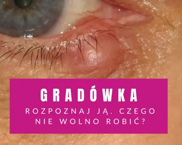 Widoczna gradówka wewnątrz powieki, czerwona i opuchnięta. Tekst informuje o rozpoznawaniu i postępowaniu.