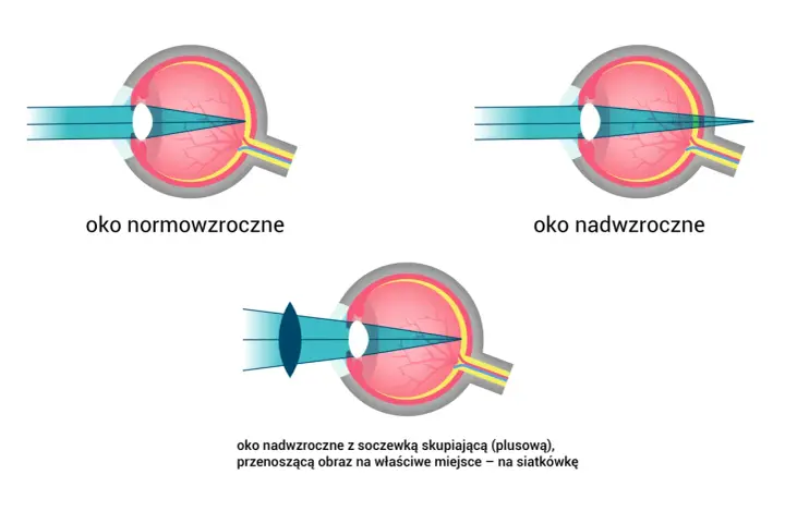 Ilustracja porównuje funkcje oka: normowzrocznego, nadwzrocznego i nadwzrocznego z soczewką korygującą, pokazując skupianie światła na siatkówce.