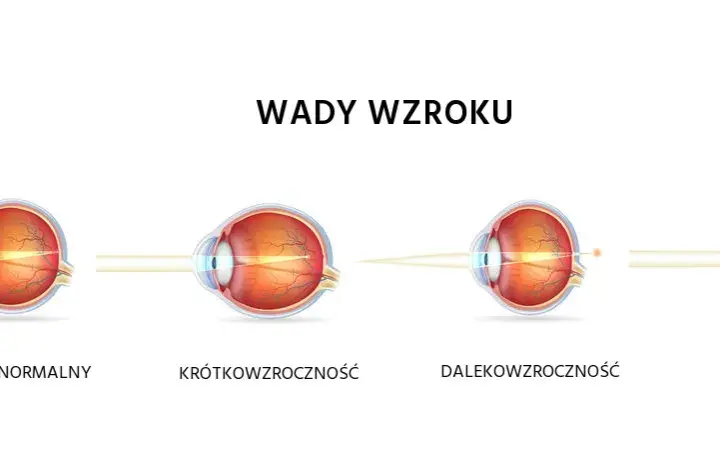 Krótkowzroczność a dalekowzroczność: Rozróżnij wady i zobacz lepiej!