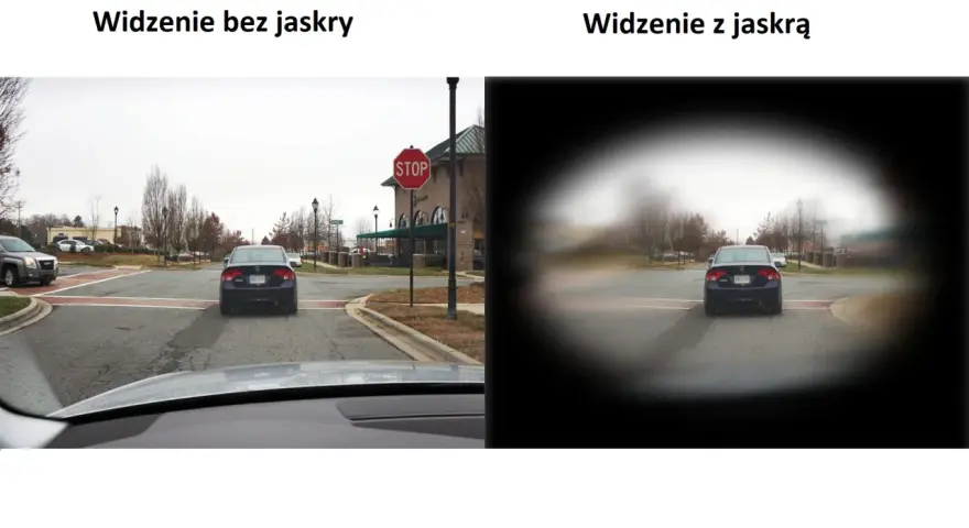 Porównanie widzenia: po lewej normalne, po prawej z jaskrą, gdzie centralne pole widzenia jest zamazane.