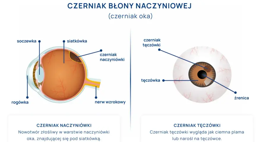 Schemat oka z zaznaczonym czerniakiem błony naczyniowej. Pokazuje czerniaka naczyniówki pod siatkówką i czerniaka tęczówki.
