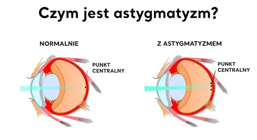 Astygmatyzm: okulary czy soczewki? Porównaj i wybierz mądrze!