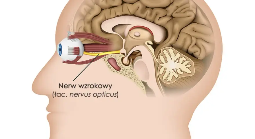 Przekrój głowy z okiem i nerwem wzrokowym. Czy zapalenie nerwu wzrokowego zawsze oznacza SM? Niekoniecznie, ale warto zbadać przyczynę.