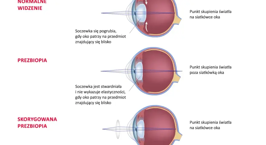 Ilustracja pokazuje, jak soczewka oka skupia światło. Przy prezbiopii soczewka jest stwardniała, co powoduje nieostre widzenie w soczewkach.