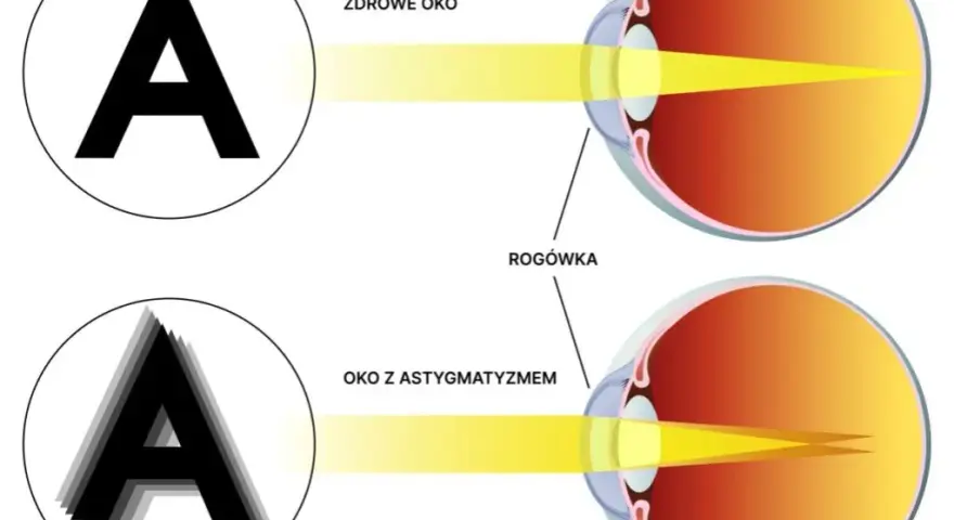 Astygmatyzm: Co to jest? Objawy, przyczyny i skuteczne korekcje