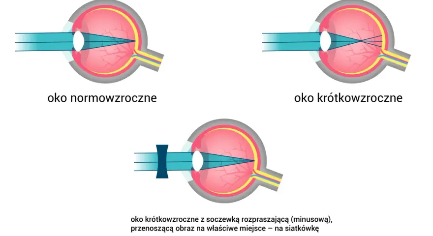 Oko normowzroczne, krótkowzroczne i krótkowzroczne z soczewką korygującą. Światło skupia się na siatkówce, a spojówka jest zdrowa.