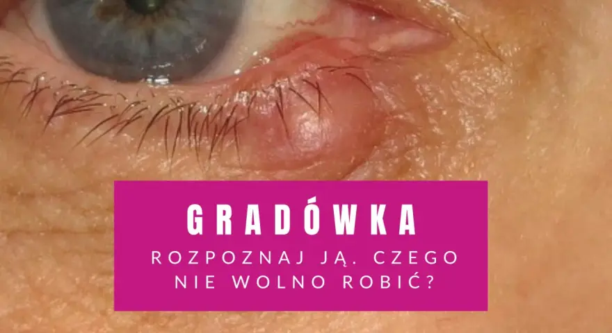 Widoczna gradówka wewnątrz powieki, czerwona i opuchnięta. Tekst informuje o rozpoznawaniu i postępowaniu.
