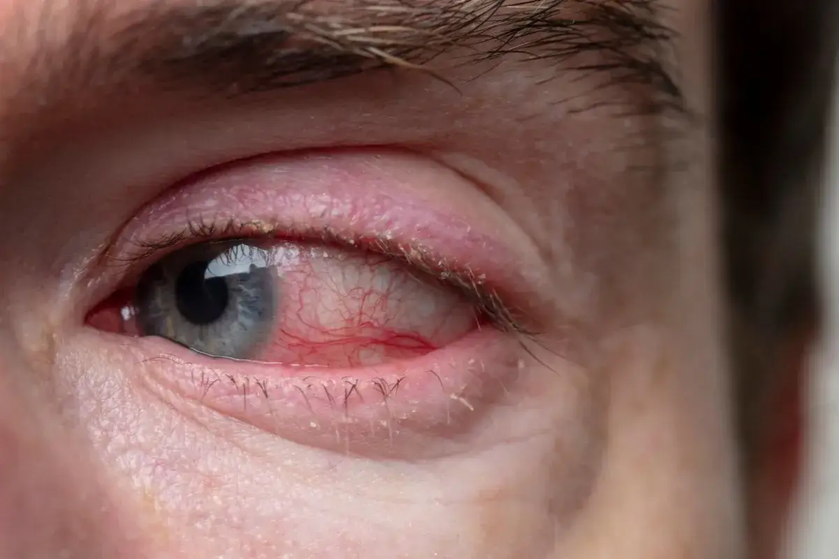 Silne zaczerwienienie oka i powieki, objawy alergicznego zapalenia spojówek. Widoczne drobne łuski na rzęsach.