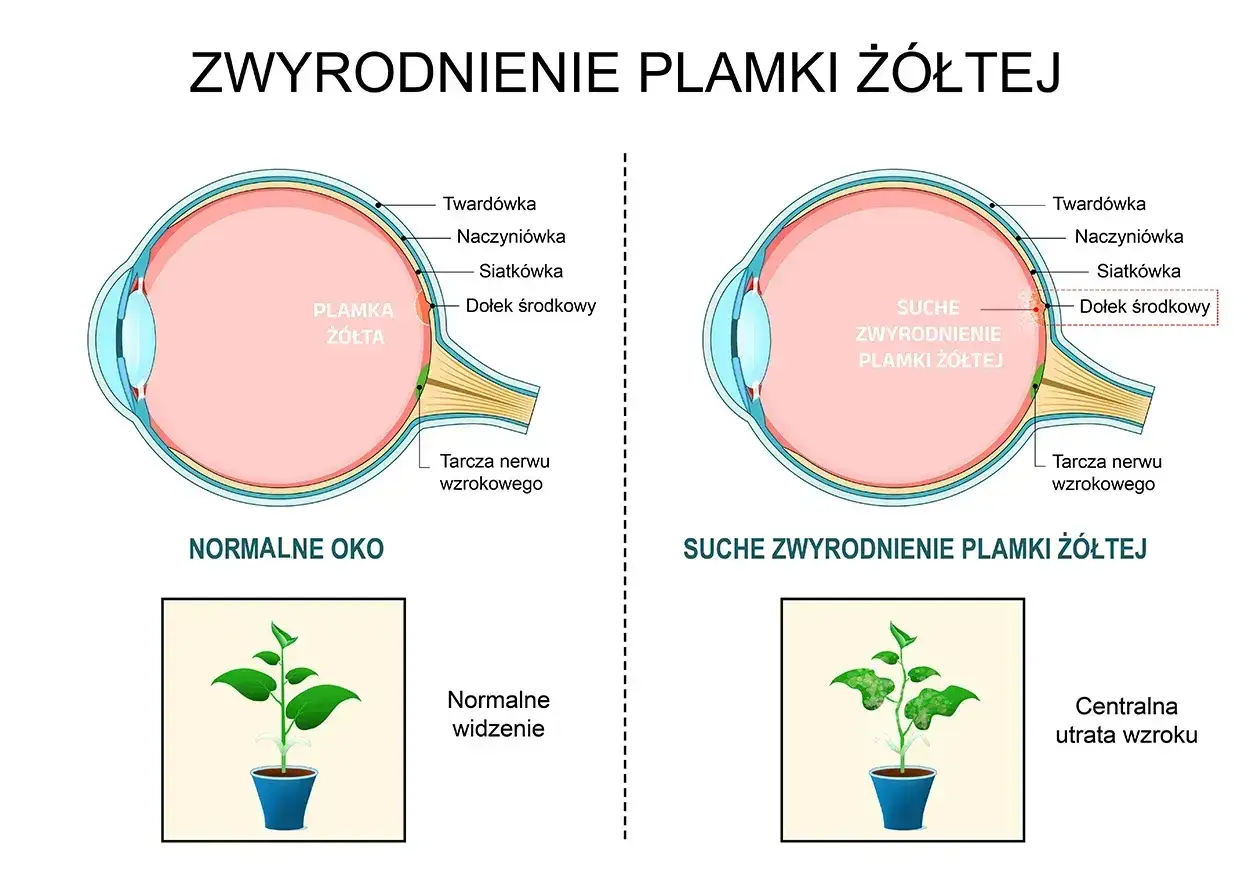 Porównanie zdrowego oka z suchym zwyrodnieniem plamki żółtej. Po prawej widoczny powidok, symbolizujący centralną utratę wzroku.