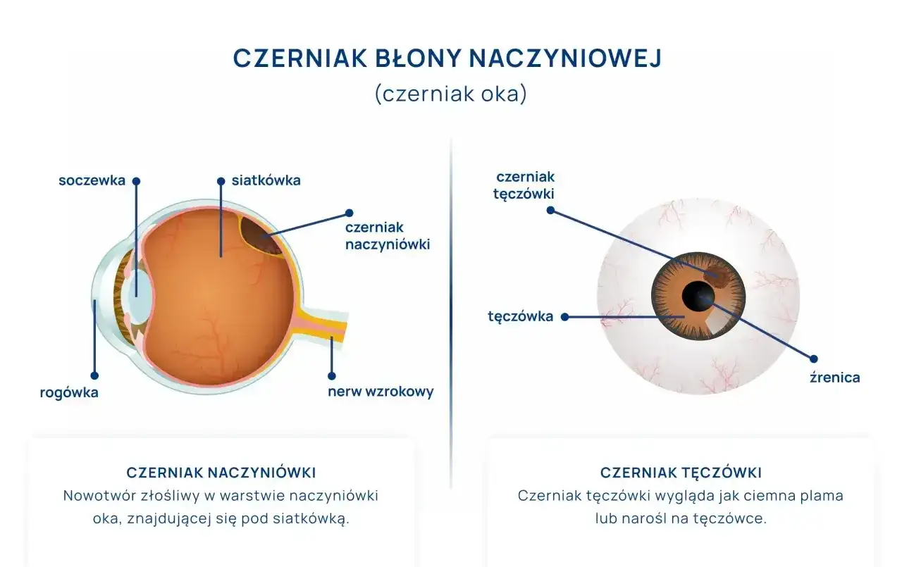 Ilustracja przedstawia przekrój oka z zaznaczonym czerniakiem naczyniówki oraz widok oka z czerniakiem tęczówki.