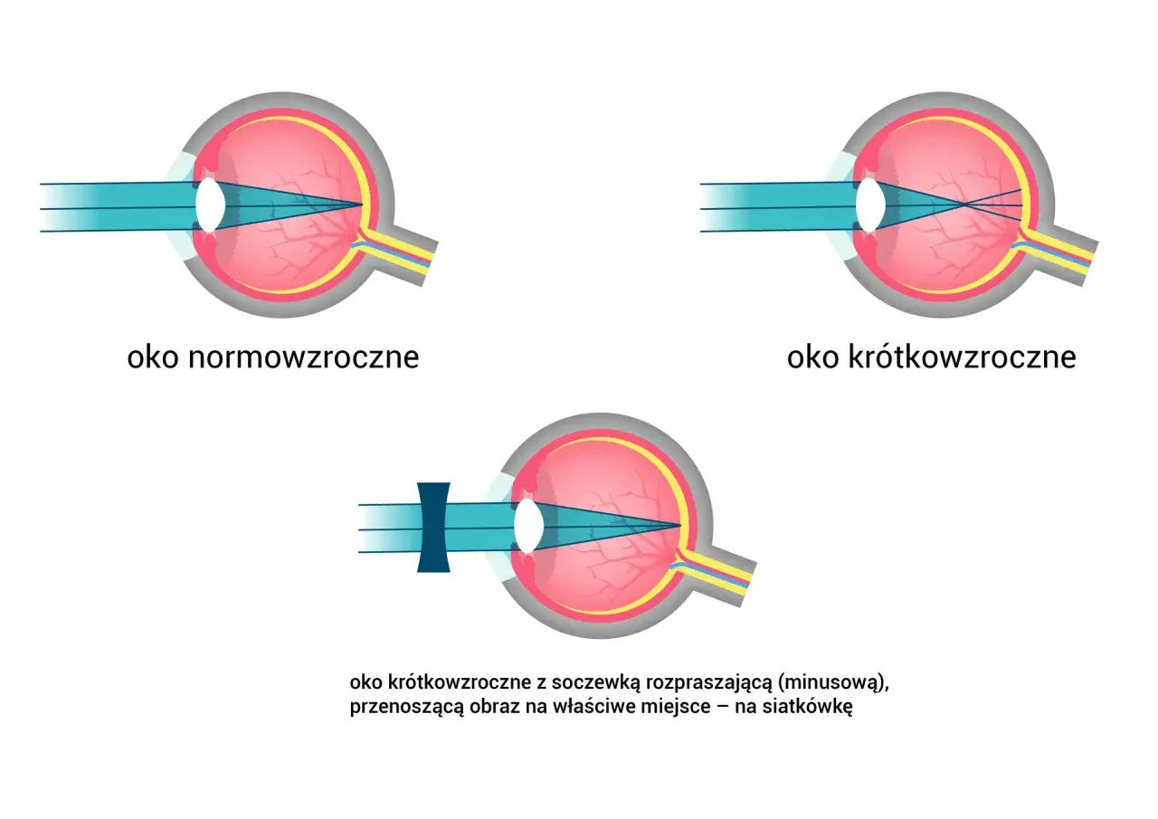 Oko normowzroczne, krótkowzroczne i krótkowzroczne z soczewką korygującą. Promienie światła skupiają się przed siatkówką, ale spojówka jest zdrowa.