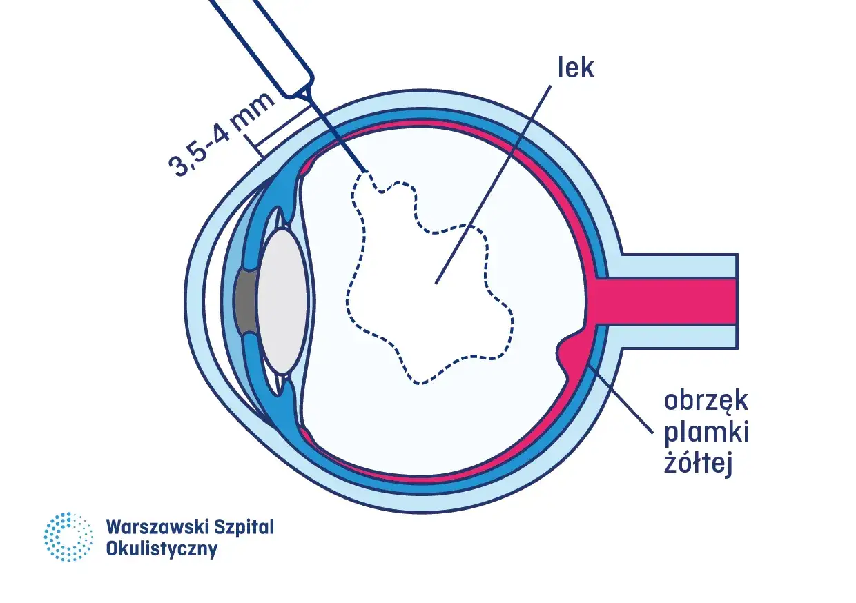 Obrzęk plamki żółtej leczony iniekcją leku.