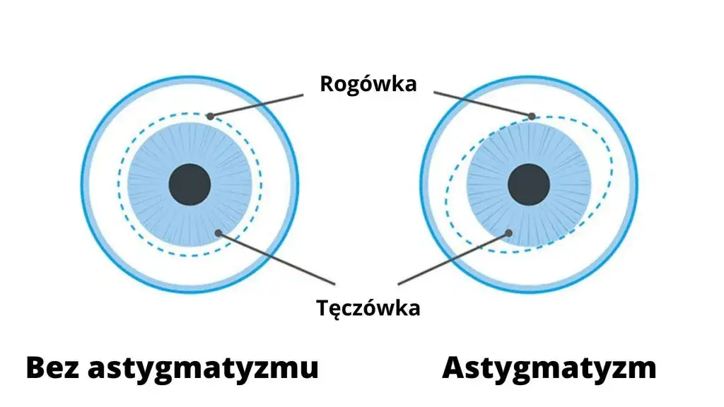astygmatyzm rogówka kształt piłki rugby