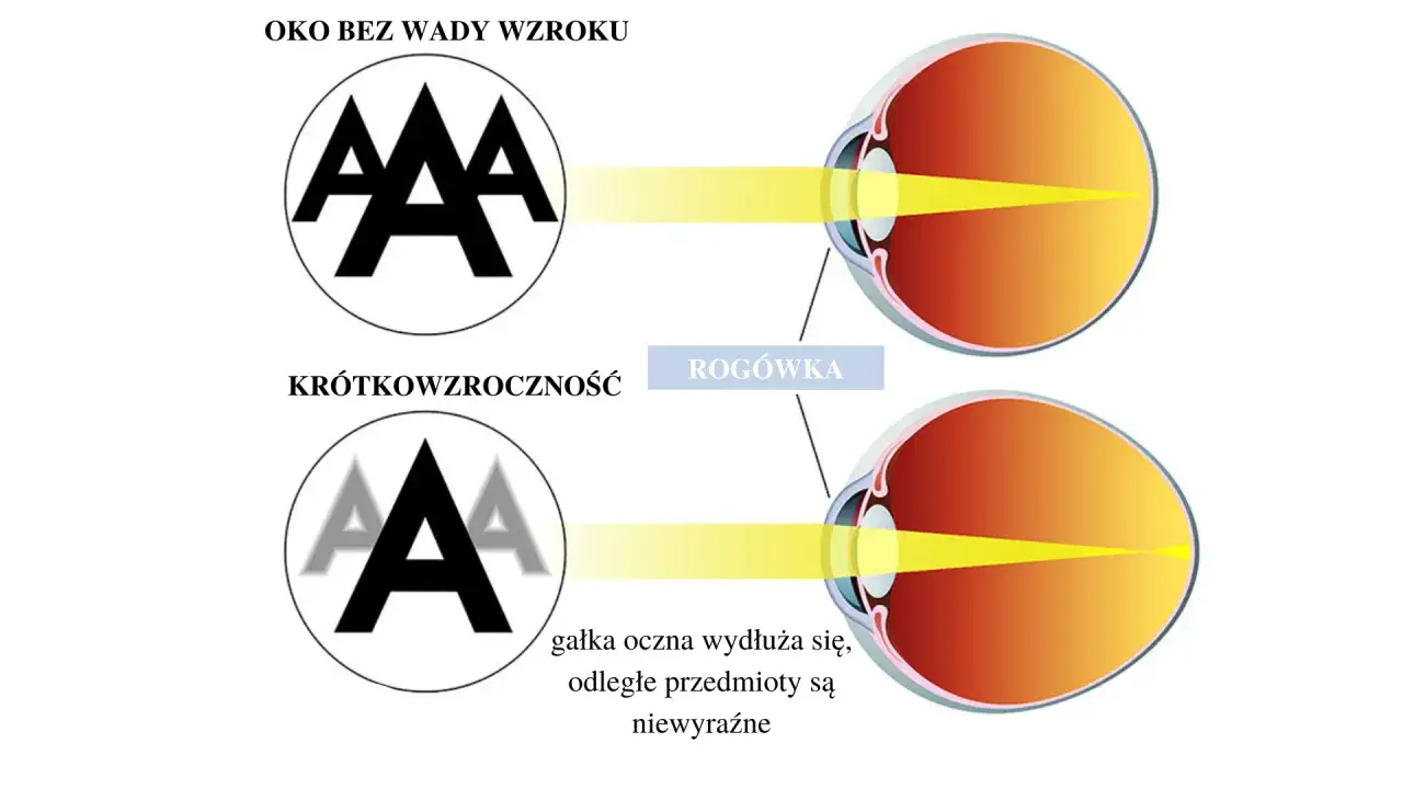 Oko bez wady wzroku ostro widzi, wady wzroku, jak krótkowzroczność, wpływają na akomodację oka, powodując niewyraźny obraz.