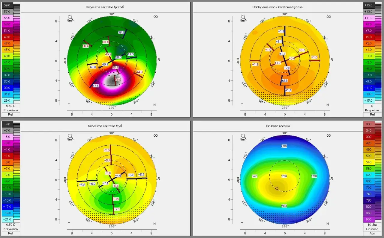 badanie wzroku astygmatyzm, topografia rogówki