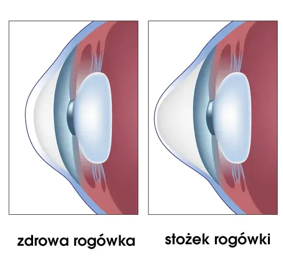 stożek rog&oacute;wki objawy por&oacute;wnanie